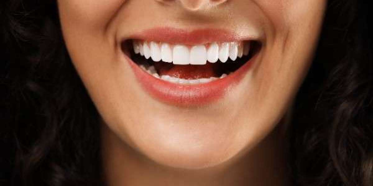 Top Teeth Whitening Solutions for Sensitive Teeth